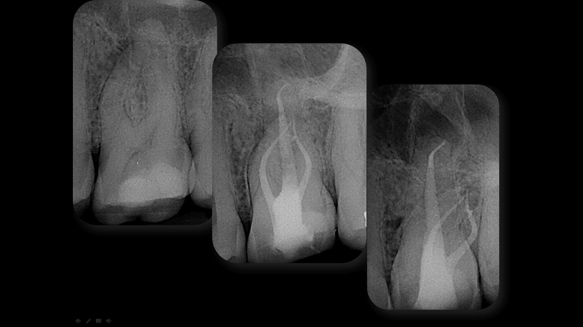 Broken Instrument Removal - Case 6